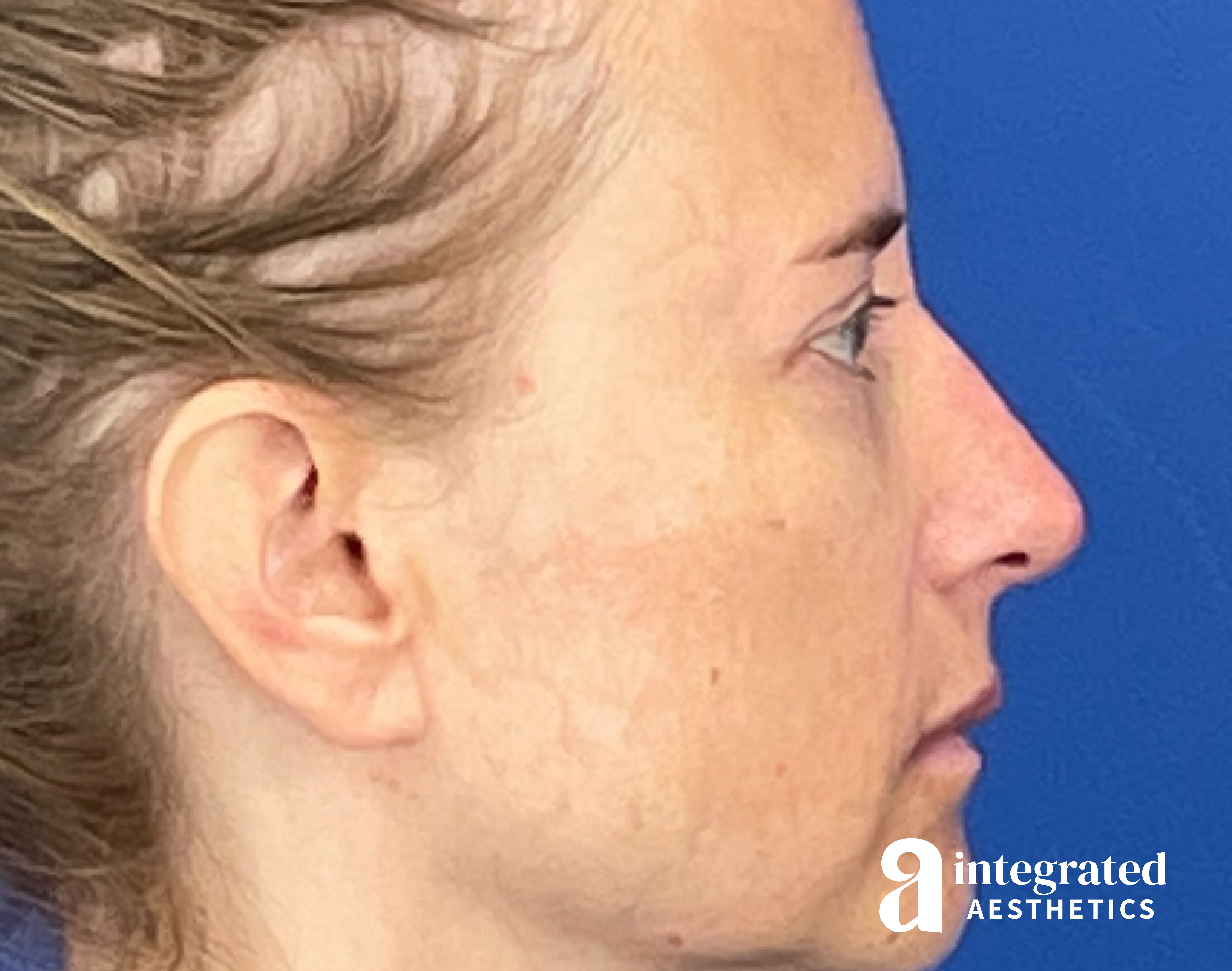 Dermal Fillers Before & After Gallery - Patient 421717 - Image 4