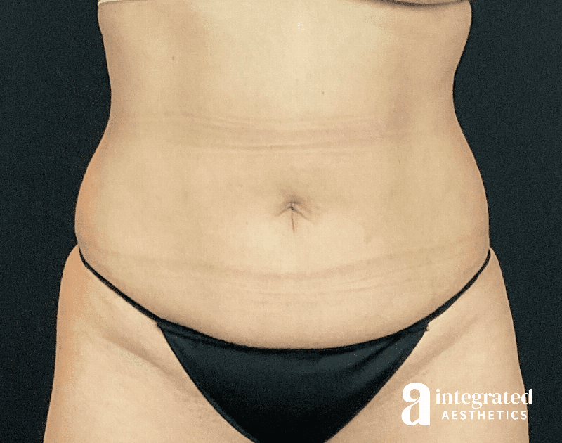 Tummy Tuck Before & After Gallery - Patient 390396 - Image 1