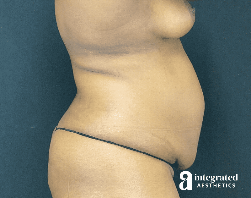 Tummy Tuck Before & After Gallery - Patient 318009 - Image 3