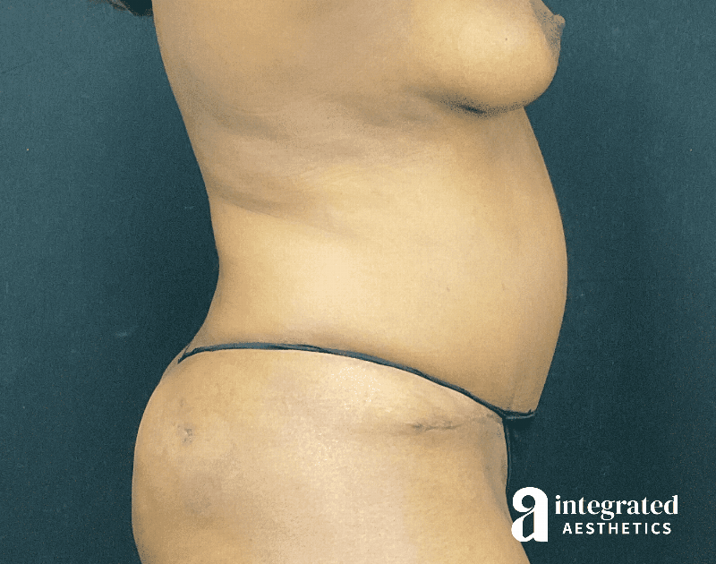 Tummy Tuck Before & After Gallery - Patient 318009 - Image 4