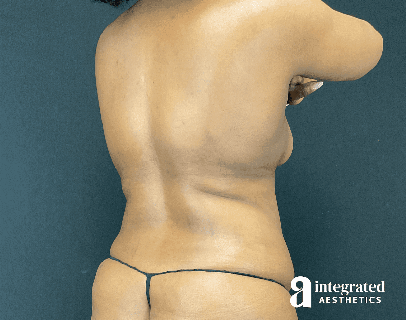 Tummy Tuck Before & After Gallery - Patient 318009 - Image 7