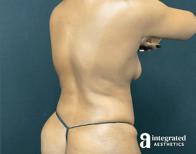 Tummy Tuck Before & After Gallery - Patient 318009 - Image 8