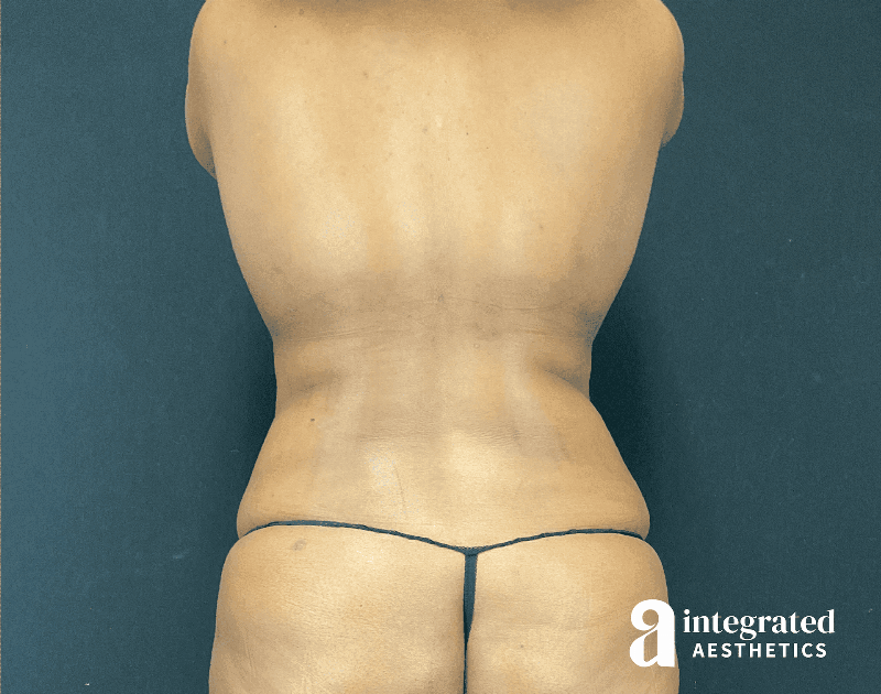 Tummy Tuck Before & After Gallery - Patient 318009 - Image 11