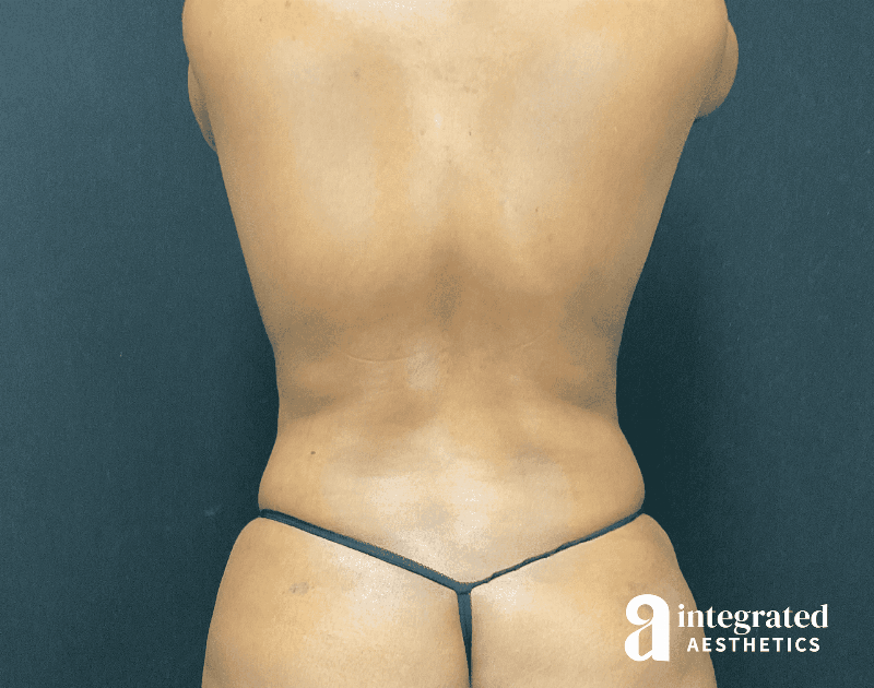 Tummy Tuck Before & After Gallery - Patient 318009 - Image 12