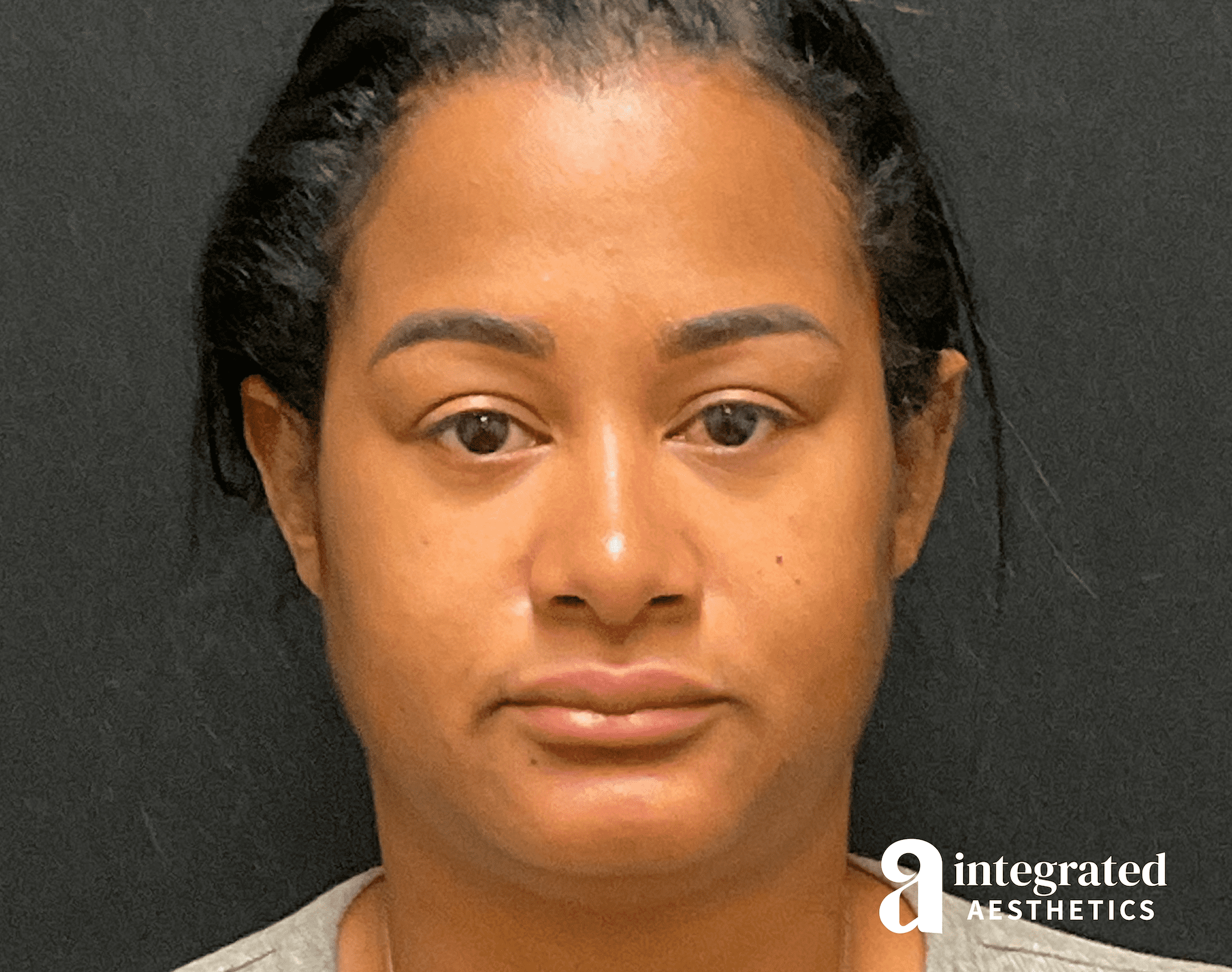 FaceTite & AccuTite Before & After Gallery - Patient 307542 - Image 1