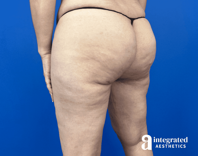 Thigh Lift Before & After Gallery - Patient 319605 - Image 4