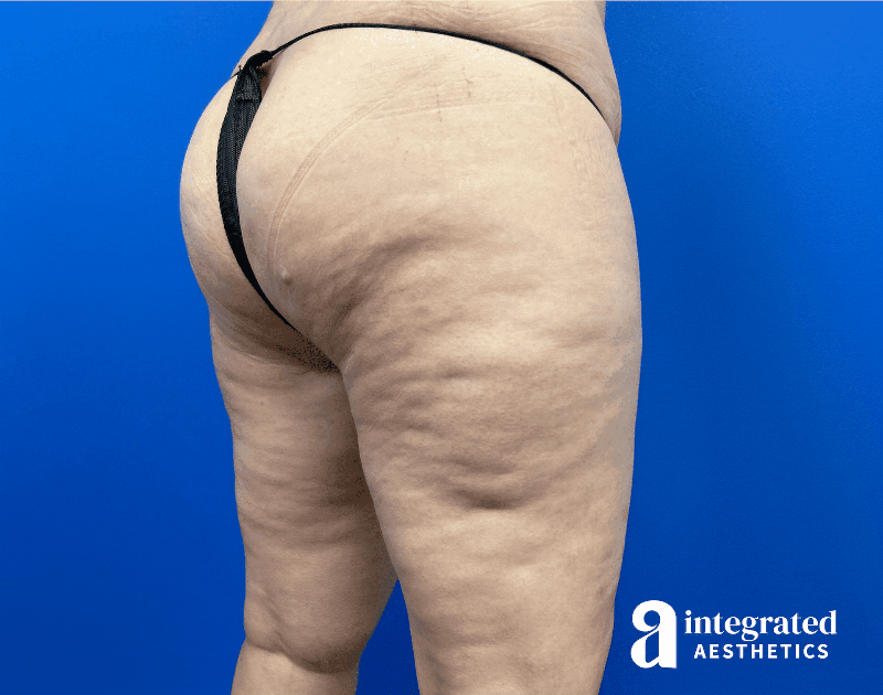 Thigh Lift Before & After Gallery - Patient 319605 - Image 5