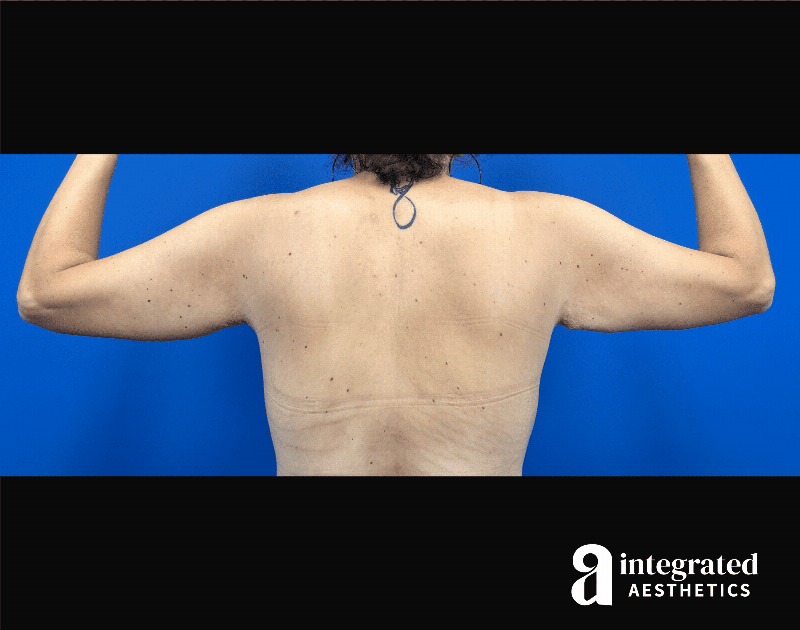 Brachioplasty Before & After Gallery - Patient 336296 - Image 1