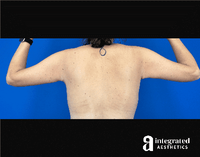 Brachioplasty Before & After Gallery - Patient 336296 - Image 2