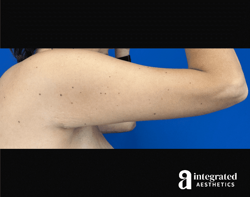 Brachioplasty Before & After Gallery - Patient 336296 - Image 4