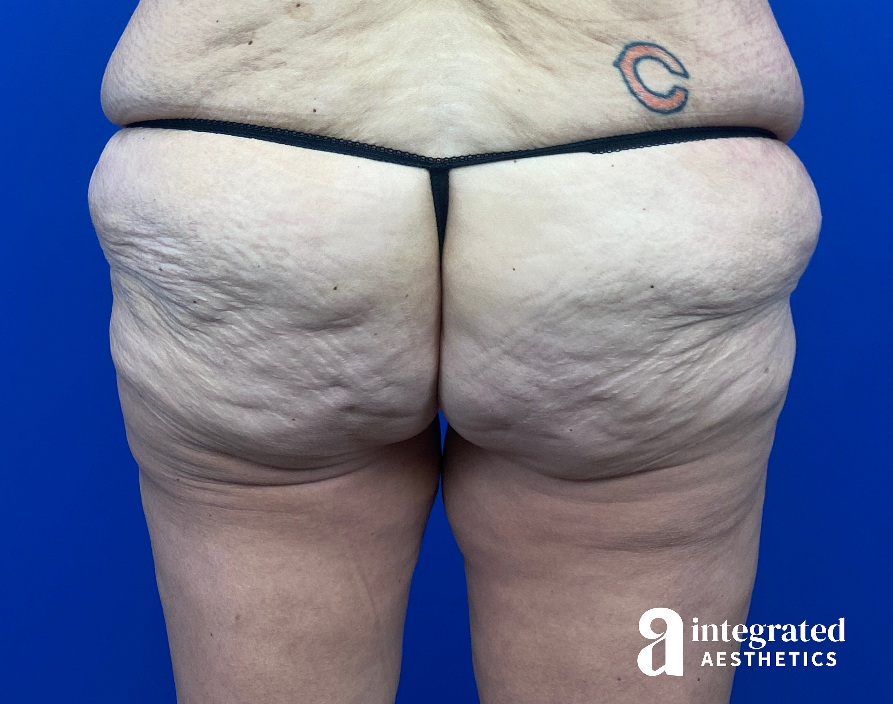 Butt Lift Before & After Gallery - Patient 354315 - Image 1