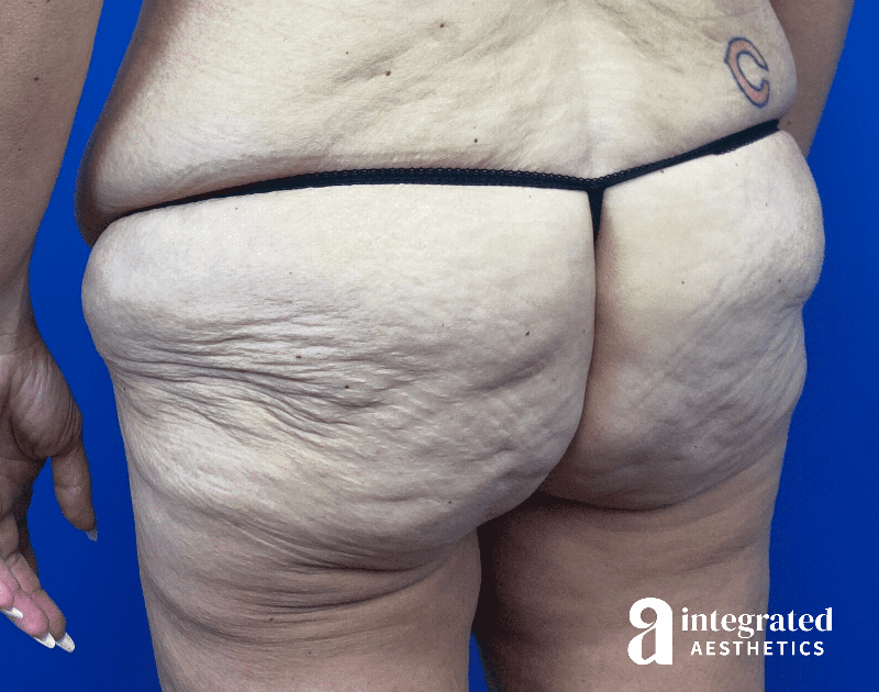 Butt Lift Before & After Gallery - Patient 354315 - Image 3