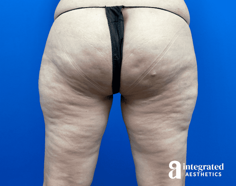 Thigh Lift Before & After Gallery - Patient 319605 - Image 1