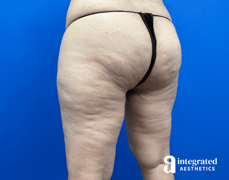 Thigh Lift Before & After Gallery - Patient 319605 - Image 3