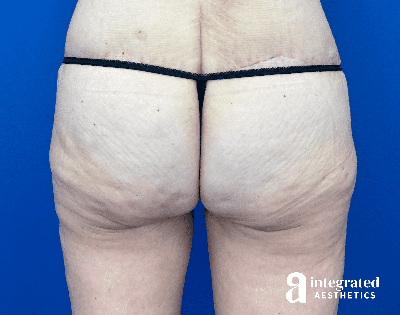 Butt Lift Before & After Gallery - Patient 354315 - Image 2