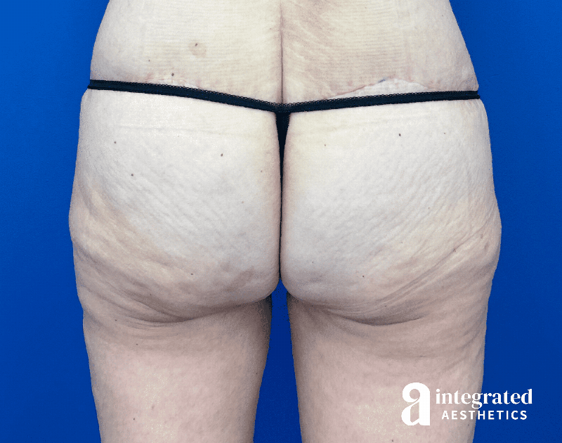 Butt Lift Before & After Gallery - Patient 354315 - Image 2