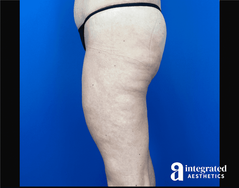 Thigh Lift Before & After Gallery - Patient 441459 - Image 8