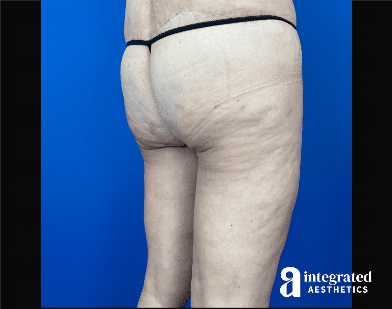 Thigh Lift Before & After Gallery - Patient 441459 - Image 4