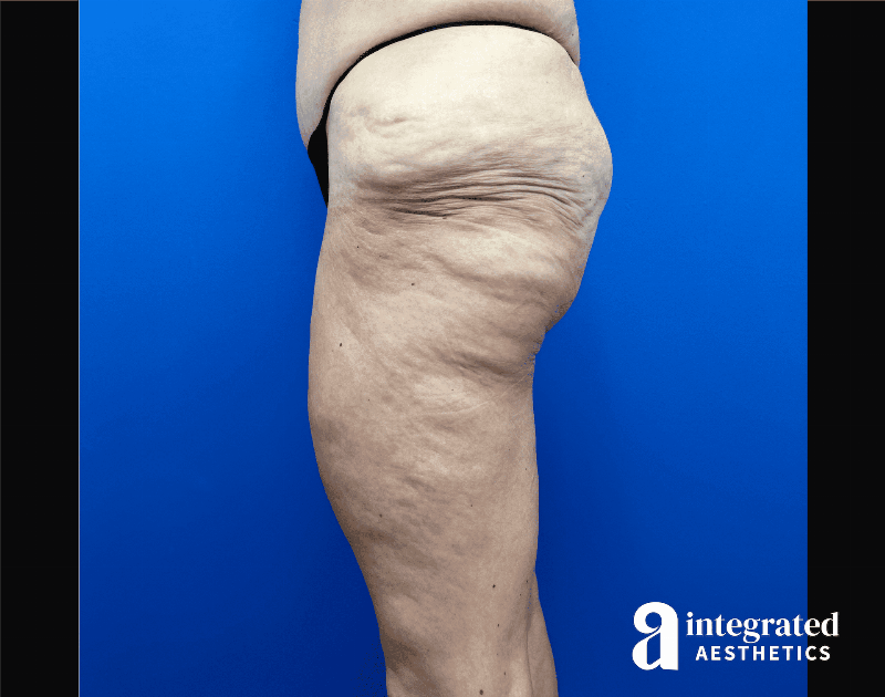 Thigh Lift Before & After Gallery - Patient 441459 - Image 7