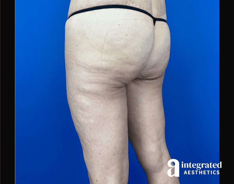 Thigh Lift Before & After Gallery - Patient 441459 - Image 6