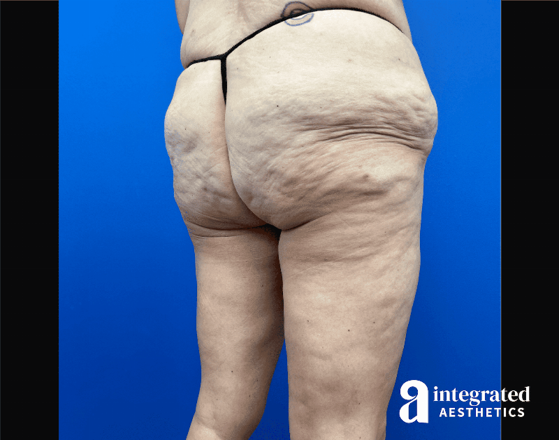 Thigh Lift Before & After Gallery - Patient 441459 - Image 3