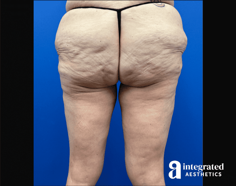 Thigh Lift Before & After Gallery - Patient 441459 - Image 1