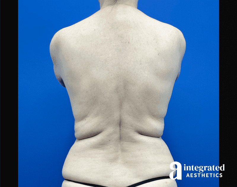 Liposuction Before & After Gallery - Patient 346039 - Image 1