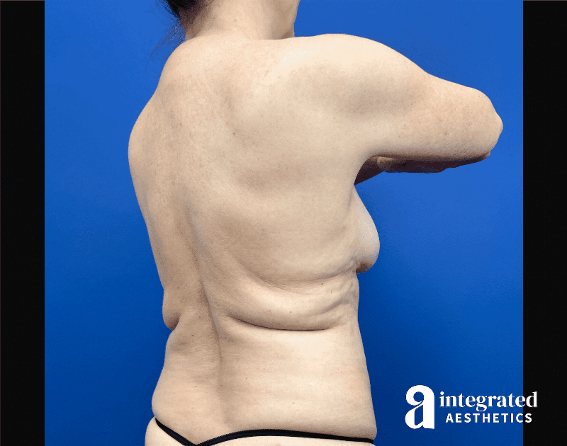 Liposuction Before & After Gallery - Patient 346039 - Image 3