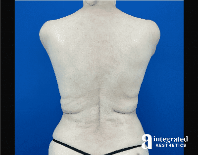 Liposuction Before & After Gallery - Patient 346039 - Image 2