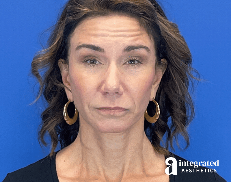 Botox Before & After Gallery - Patient 262834 - Image 5