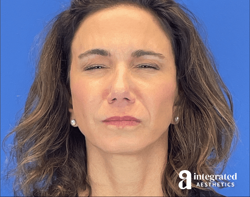 Botox Before & After Gallery - Patient 262834 - Image 10