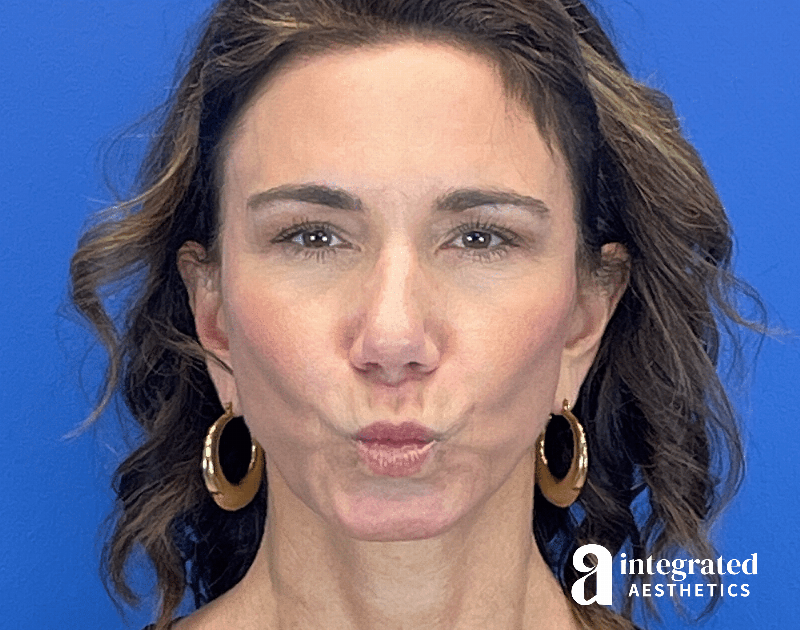 Botox Before & After Gallery - Patient 262834 - Image 3