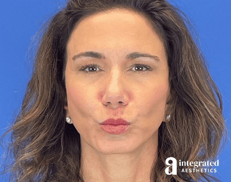 Botox Before & After Gallery - Patient 262834 - Image 4