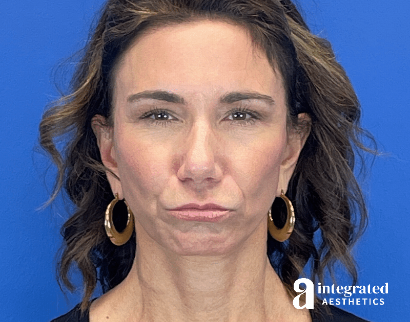 Botox Before & After Gallery - Patient 262834 - Image 7