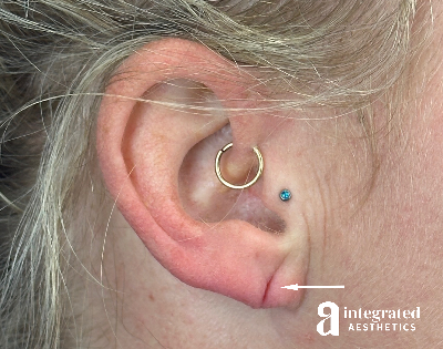 Earlobe Repair Before & After Gallery - Patient 294545 - Image 1