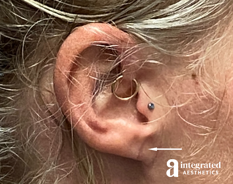 Earlobe Repair Before & After Gallery - Patient 294545 - Image 2