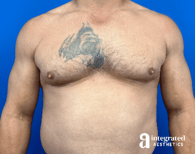 Gynecomastia Before & After Gallery - Patient 354427 - Image 1