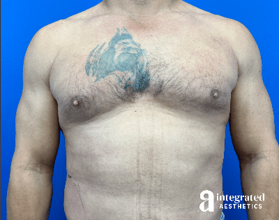 Gynecomastia Before & After Gallery - Patient 354427 - Image 2