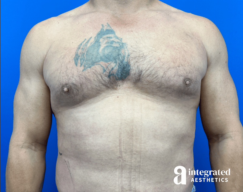 Gynecomastia Before & After Gallery - Patient 354427 - Image 2