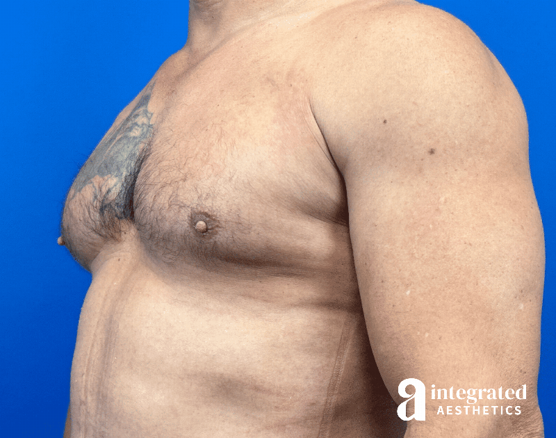 Gynecomastia Before & After Gallery - Patient 354427 - Image 6