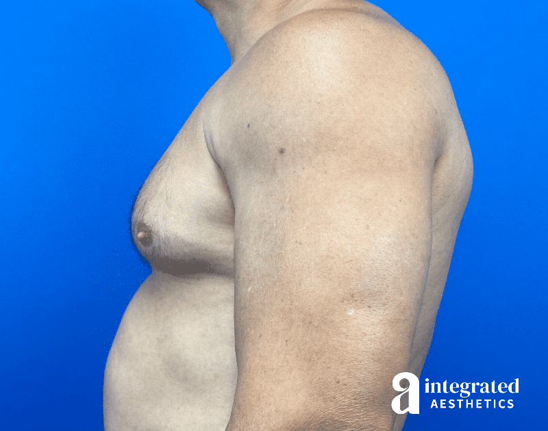 Gynecomastia Before & After Gallery - Patient 354427 - Image 7