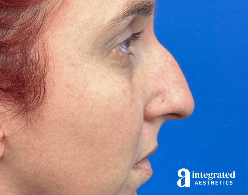 Rhinoplasty Before & After Gallery - Patient 985444 - Image 7