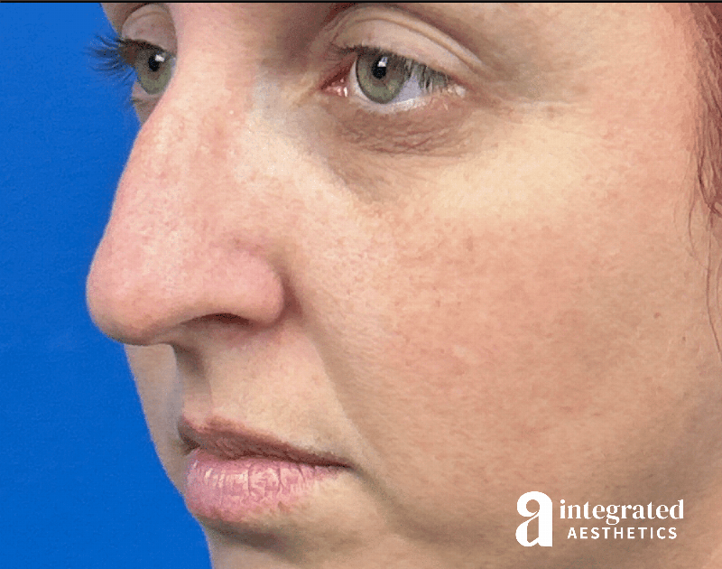 Rhinoplasty Before & After Gallery - Patient 985444 - Image 3