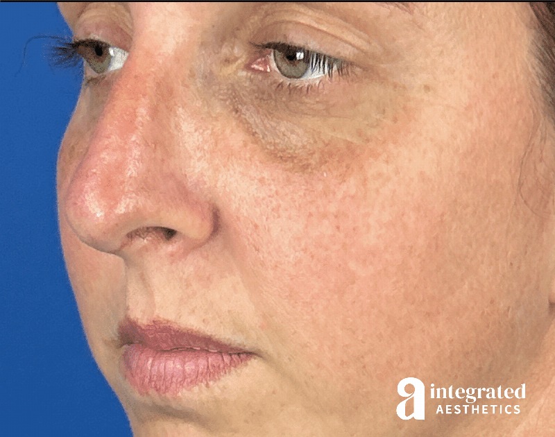 Rhinoplasty Before & After Gallery - Patient 985444 - Image 4