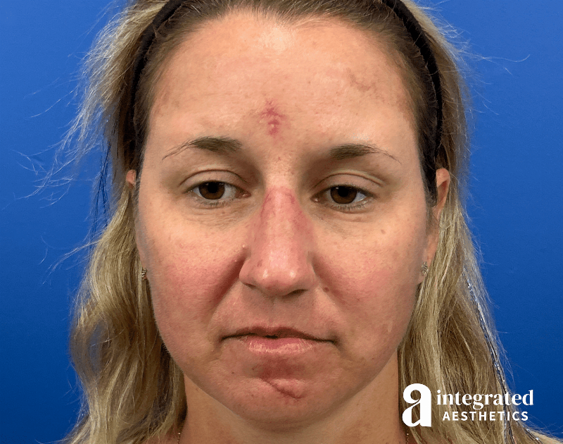 Scar Revision Before & After Gallery - Patient 413755 - Image 3