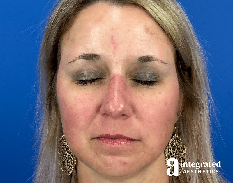 Scar Revision Before & After Gallery - Patient 413755 - Image 4