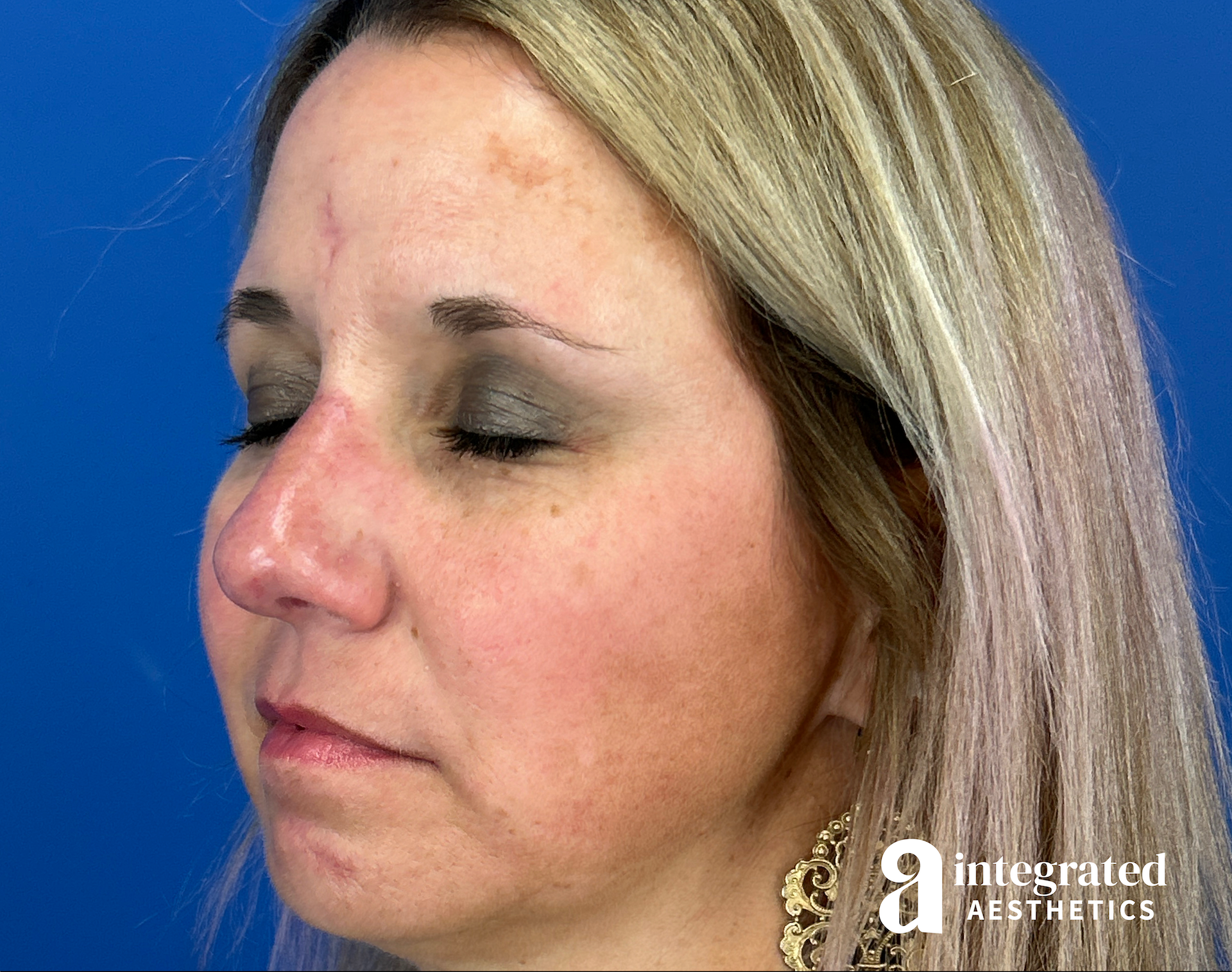 Scar Revision Before & After Gallery - Patient 413755 - Image 6