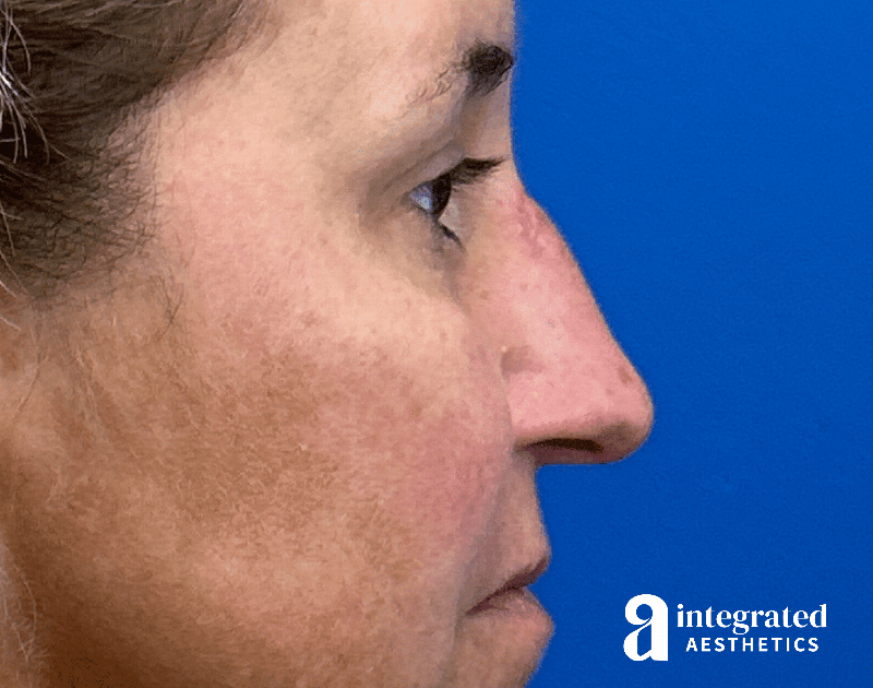 Scar Revision Before & After Gallery - Patient 413755 - Image 1