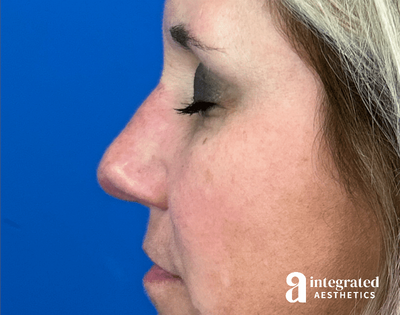 Scar Revision Before & After Gallery - Patient 413755 - Image 10