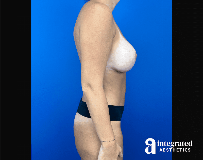 Mommy Makeover Before & After Gallery - Patient 619644 - Image 6